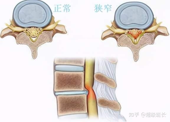 腰椎管狹窄手術(shù)成功率高嗎？都是怎樣做的？