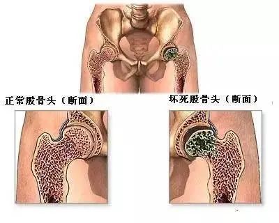 股骨頭壞死不疼了是好還是壞？