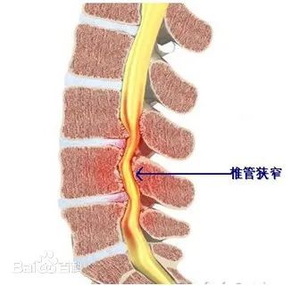 什么是腰椎管狹窄癥？