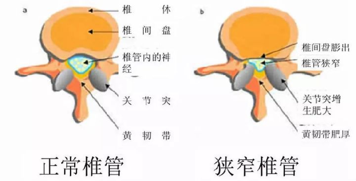 腰椎管狹窄是如何引起的