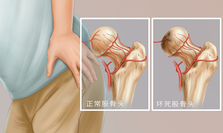 判斷股骨頭壞死的幾種方法，學(xué)會(huì)了不吃虧！