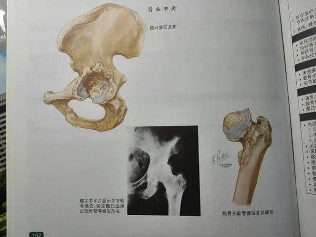 股骨頭壞死原因和康復