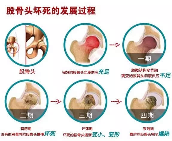 股骨頭壞死會造成患者哪里疼痛