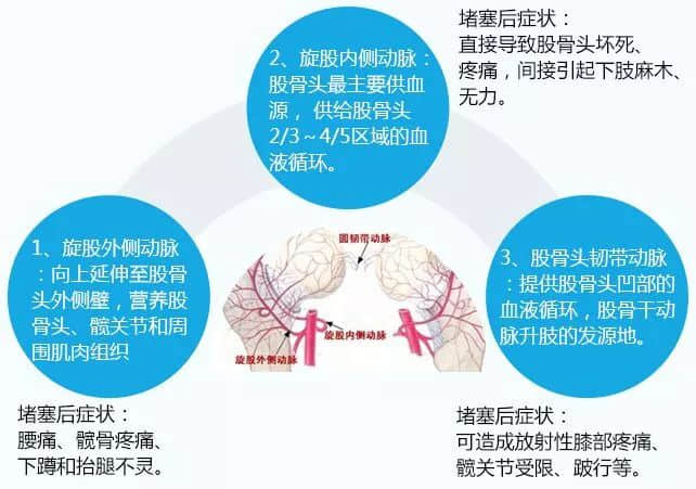 股骨頭壞死患者為什么不能久站或久坐