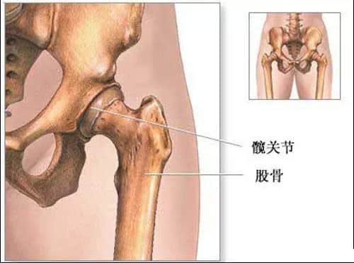 蓮池骨科醫(yī)院-股骨頭壞死患者，哪些情況下要做置換手術(shù)了？