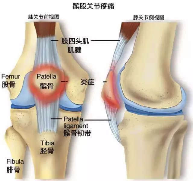 蓮池骨科醫(yī)院-髕骨疼痛綜合和跑步膝是什么關系