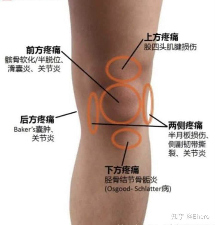 膝蓋疼痛是什么原因引起的