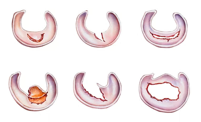 半月板撕裂的6種類型