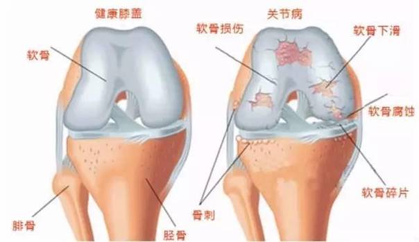 關(guān)節(jié)軟骨到底指什么？