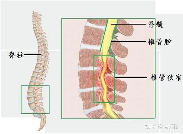 椎管狹窄是什么意思？嚴(yán)重嗎?