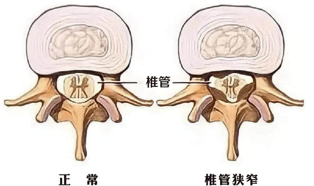 腰椎椎管狹窄癥？試試UBE技術(shù)！