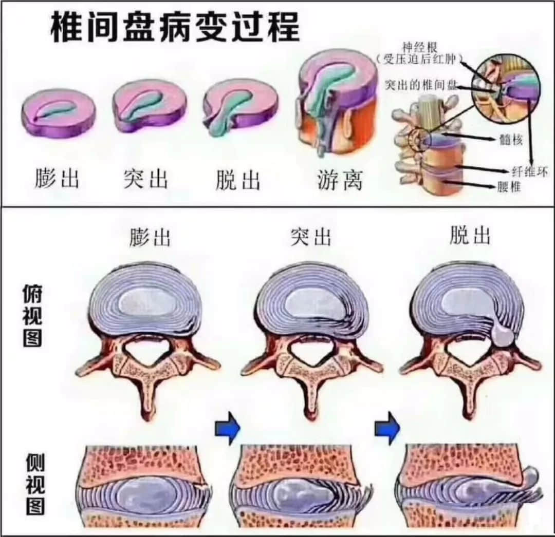 腰椎間盤突出，纖維環(huán)破裂是怎么回事？這種情況需要治療嗎？